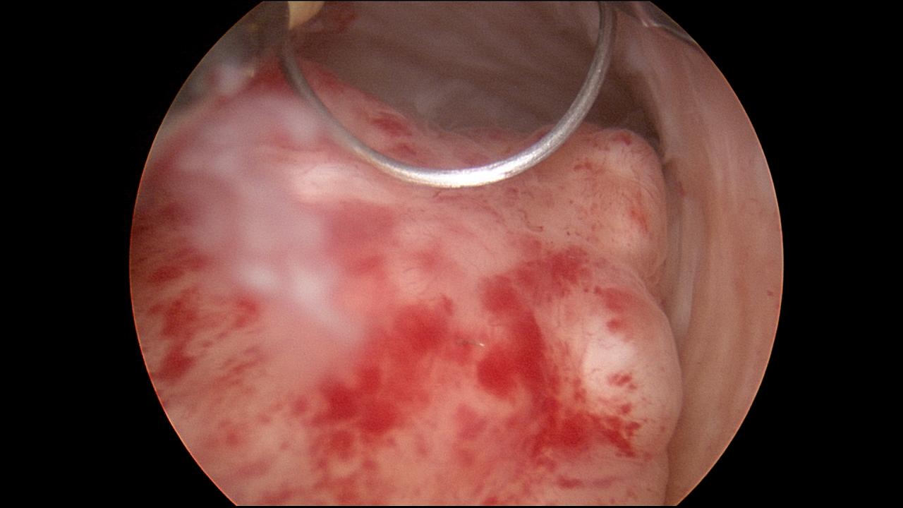 Submucus Fibroid Hysteroscopic Resection 2